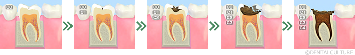 むし歯の進行図