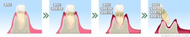 歯周病の進行図